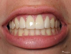 Медики научились лечить зубы без пломб