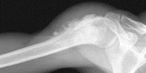 Остеогенная саркома