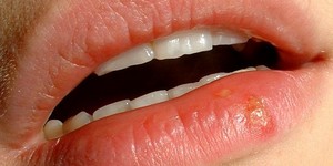 Герпес: виды и лечение