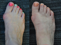 Красивые стопы: как избавиться от косточки без операции - «Здоровье»