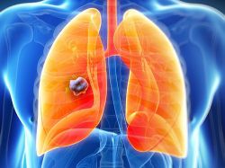 Невидимый и коварный: что надо знать о раке легкого