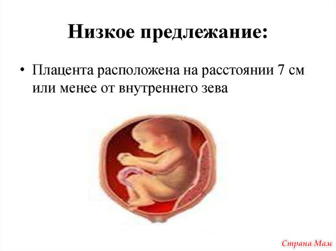 Проблемы низкой плацентации: диагноз, лечение - «Беременность»