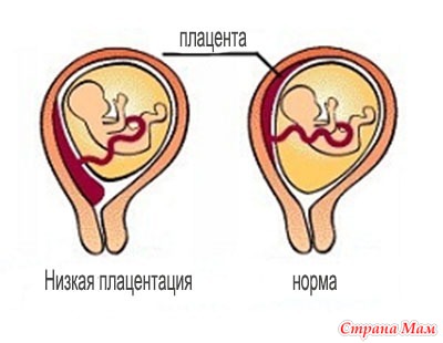 Низкая плацентация: что это такое? - «Беременность»