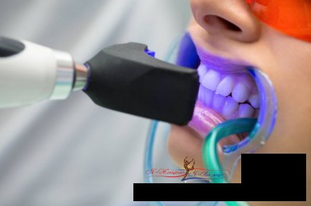 Лазерная стоматология: на что нужно обратить внимание