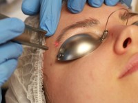 Тест-драйв: как удалить татуаж бровей - «Я и Красота»