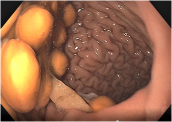 Битва за урожай: из желудка ребенка извлекли 33 косточки черешни - «Я и Здоровье»