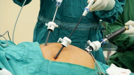 Лапароскопия рубца на матке: операция без скальпеля