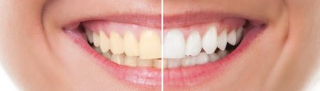 Что важно знать об отбеливании зубов? - «Я и Здоровье»