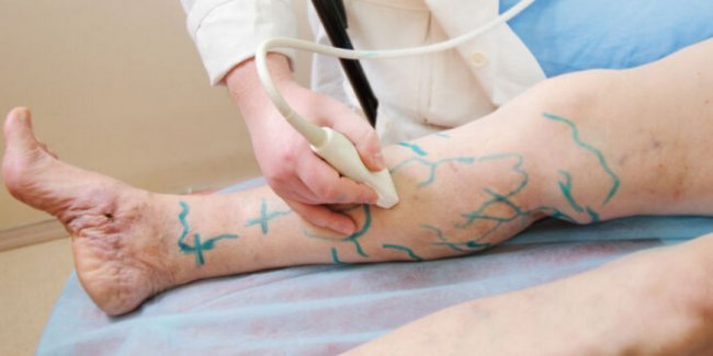 Что желательно знать о варикозном расширении - «Здоровье»