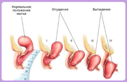 Выпадение матки — серьезное медицинское изменение